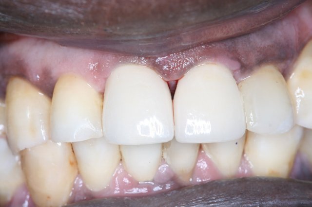 Crowns After